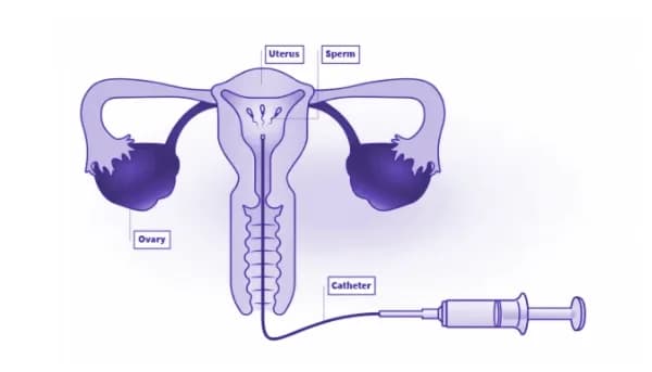 Seluk Beluk Inseminasi Intrauterin (IUI) 