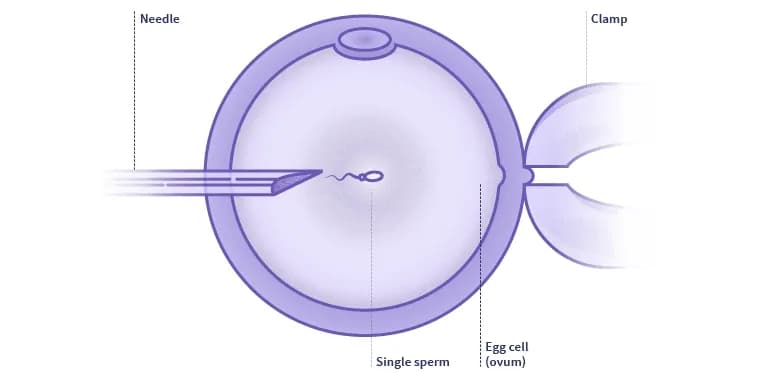 Apa itu Intracytoplasmic Sperm Injection (ICSI)?