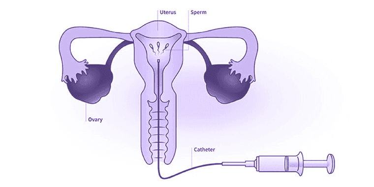 Tinjauan Perawatan Fertilitas