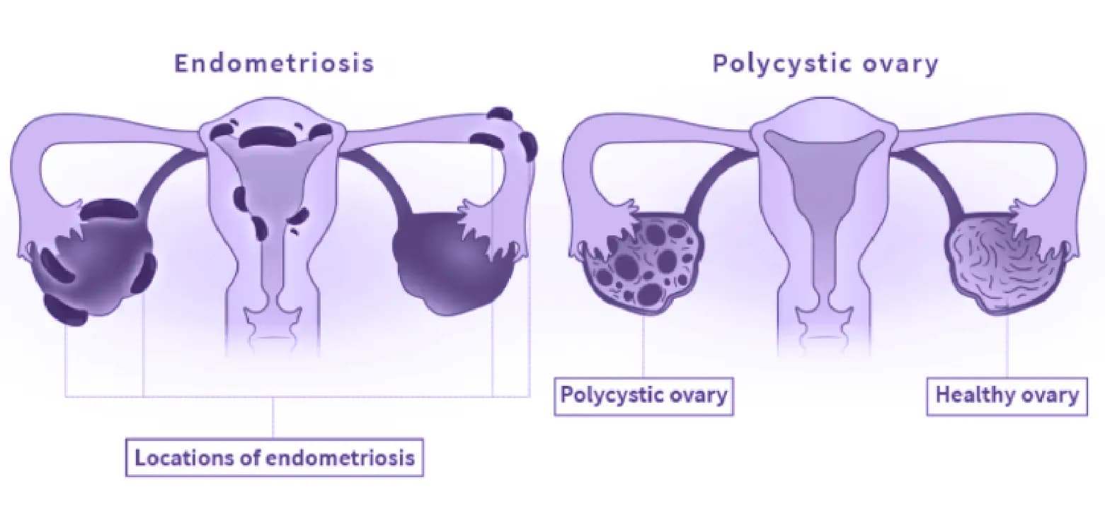 Fertilisasi In Vitro (IVF) 