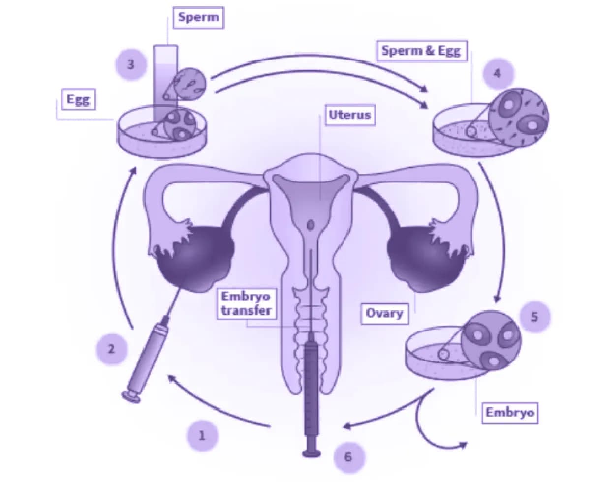 Fertilisasi In Vitro (IVF) 