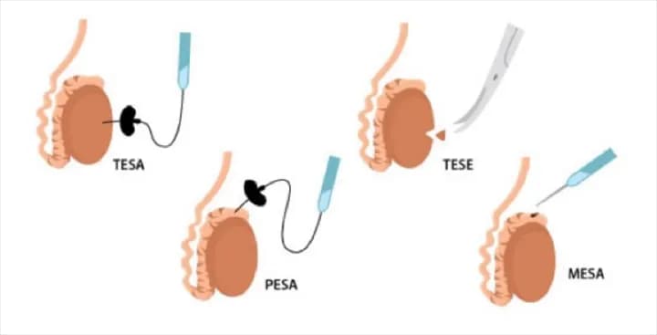 Azoospermia? Jangan Cemas Dulu!