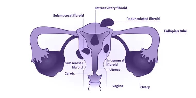 Penyebab Infertilitas Pada Wanita