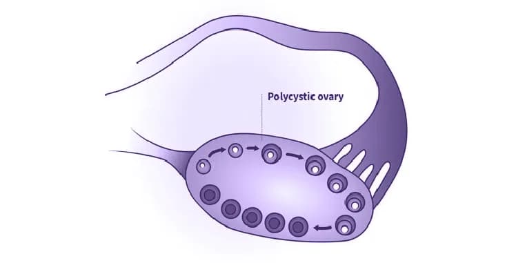 Penyebab Infertilitas Pada Wanita