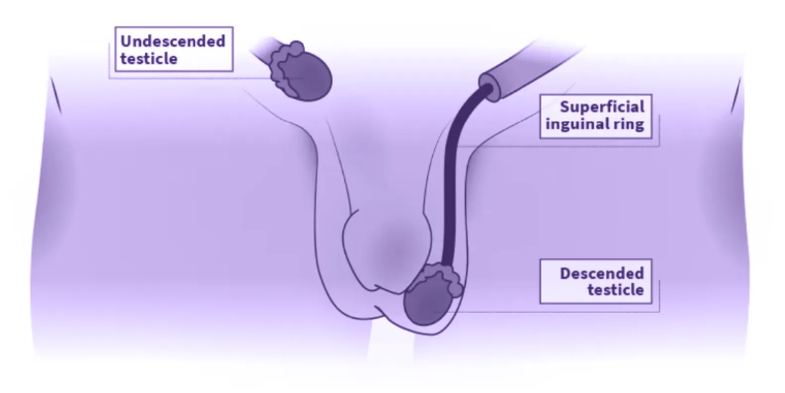 Penyebab Infertilitas pada Pria